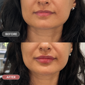 lip filler treatment before after images