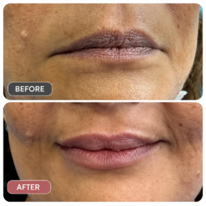 lip fillers at dermasure clinic